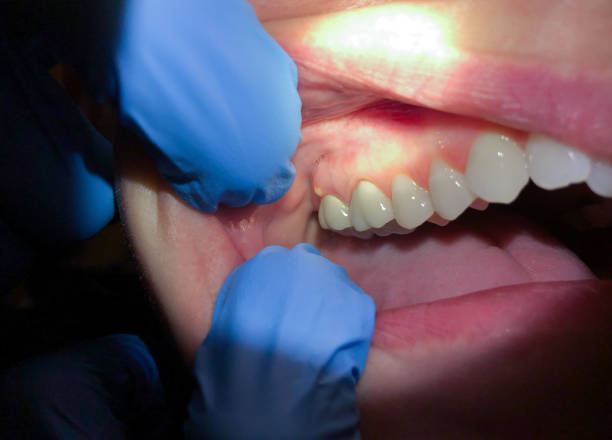 Best Broken or Cracked Tooth Emergency Dentist in Sarcoxie, MO