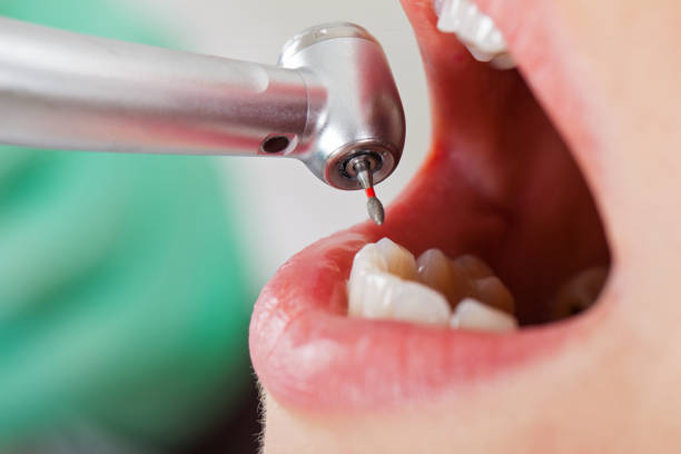 Best Emergency Root Canal Treatment in Sarcoxie, MO
